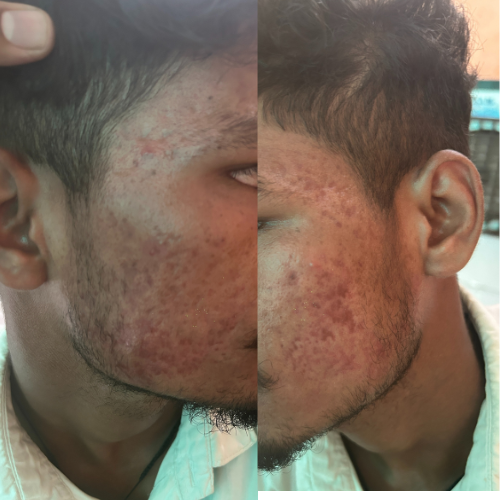 Active Acne Treatment Result